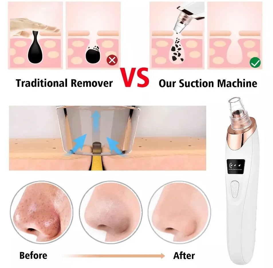 5in1 Blackhead Remover Machine Rechargeable | Face Vacuum Derma | Blackhead Removing Machine